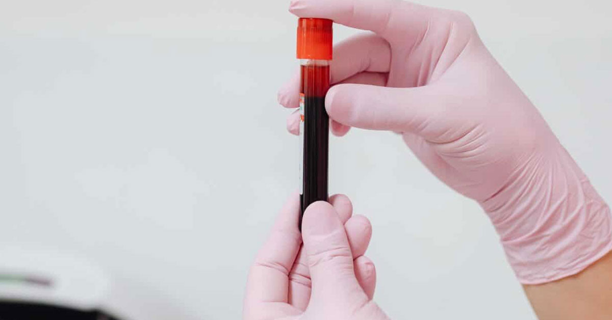 Genetik bir rahatsızlık olan hemofili hastalığına sahip bireylerin yaşam kalitesinin iyileşmesi adına Trakya Üniversitesi Tıp Fakültesi İç Hastalıkları ve Hematoloji Bilim Dalı Öğretim Üyesi Prof. Dr. Ahmet Muzaffer Demir, bakım ve tedavide çeşitli gelişmelerin yaşandığını fakat hala birçok karşılanmamış ihtiyacın olduğunun altını çizdi. Genetik bir rahatsızlık olan hemofili hastalığına sahip bireylerin yaşam kalitesinin iyileşmesi adına Trakya Üniversitesi Tıp Fakültesi İç Hastalıkları ve Hematoloji Bilim Dalı Öğretim Üyesi Prof. Dr. Ahmet Muzaffer Demir, bakım ve tedavide çeşitli gelişmelerin yaşandığını fakat hala birçok karşılanmamış ihtiyacın olduğunun altını çizdi.