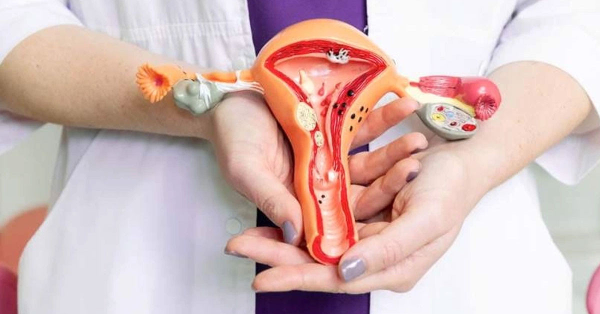 Kadınlarda rahimlerinde çikolata kisti neden olur? Belirtileri nelerdir? Kadınlarda rahimlerinde çikolata kisti neden olur? Belirtileri nelerdir?