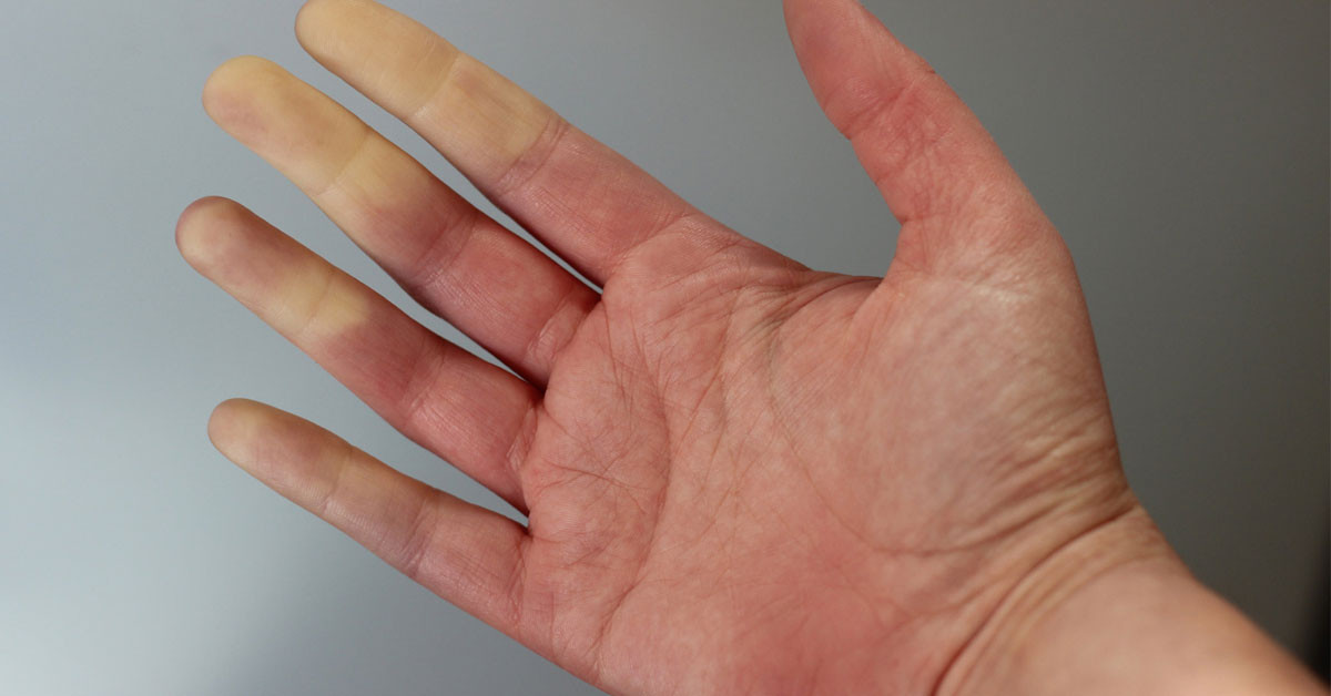Raynaud Hastalığı