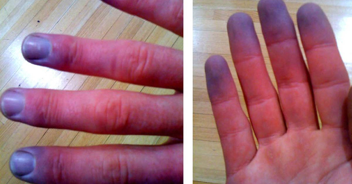 Raynaud Hastalığı