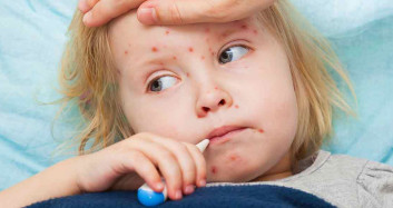 Bir zamanların Korona’sı: Çiçek hastalığı nedir? Belirtileri nelerdir?