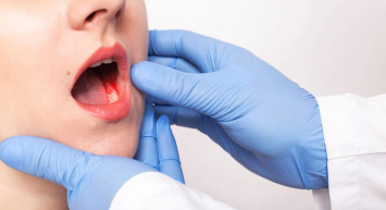 Ağız kanseri nedir, belirtileri nelerdir? Ağız içerisindeki iyileşmeyen yaralar ağzı kanserinin habercisi