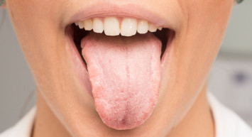 Ağız kuruluğu nedir, neden olur, belirtileri nelerdir, nasıl tedavi edilir? Ağız kuruluğu o hastalıkların habercisi