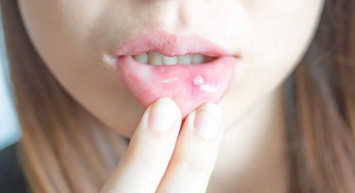 Ağız Yarasına Ne İyi Gelir?