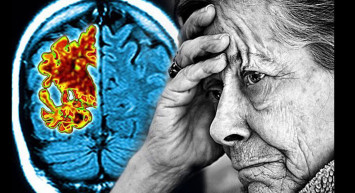 Alzheimer hastalığı artık tarihe karışıyor! Hastalara tünelin ucunda ışık göründü!
