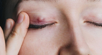 Arpacık neden çıkar? Nasıl geçer? Belirtileri nelerdir?