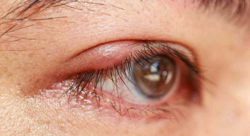 Arpacık nedir, neden olur, nasıl geçer? Arpacığa karşı savaşan 4 etkili doğal çözüm