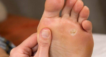 Ayak çıbanı nedir? Tedavi yöntemleri nelerdir?