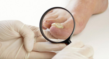 Ayak mantarı nedir, belirtileri nelerdir, ağrı yapar mı, bulaşıcı mıdır? Ayak mantarına iyi gelen doğal ve bitkisel yöntemler 