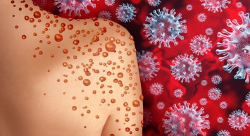 Bakan Memişoğlu'ndan Maymun Çiçeği Virüsü Hakkında Önemli Açıklamalar: "Pandemi Olmaz"