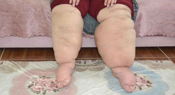 Batman'da yaşayan kadının hayatı kabusa döndü: 15 yıldır hastalığına teşhis konulamıyor!