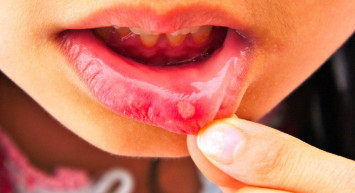 Behçet hastalığı nedir? Tedavi yöntemleri nelerdir?