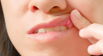 Behçet hastalığı nedir, belirtileri nelerdir, kendiliğinden geçer mi, bulaşıcı mıdır, tedavisi var mı? Körlüğe yol açan Behçet hastalığıyla ilgili bilinmesi gerekenler