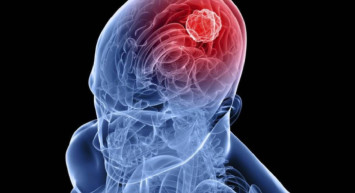 Beyine pıhtı attığını nasıl anlarsın? Beyin pıhtı atma nasıl oluyor? Beyinde pıhtı belirtileri