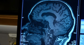 Bir Hastalığın Daha Çaresi Bulundu! Bilim insanları Alzheimer'ı Durdurmanın Yöntemini Açıkladı