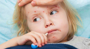 Bir zamanların Korona’sı: Çiçek hastalığı nedir? Belirtileri nelerdir?