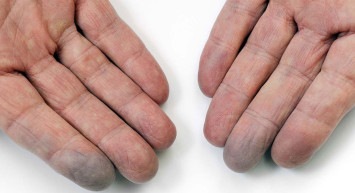 Buerger Hastalığı Nedir, Belirtileri Nelerdir, Nasıl Tedavi Edilir?