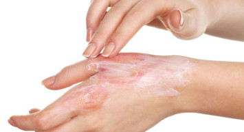 Çay Dökülmesine Ne İyi Gelir, Çay Dökülmesine Ne Yapılır?