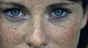 Çiller nedir? Neden oluşur? Türleri nelerdir? Tedavisi nasıl yapılır?