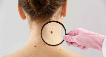 Cilt Kanseri Belirtileri Nelerdir?