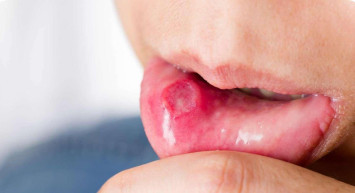 Dilde sivilce çıkmasının nedenleri nelerdir? Dilde sivilce çıkmasına ne iyi gelir? Hayat kalitesini düşüren problemlerden dilde sivilce çıkmasının sebepleri