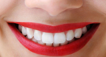 Diş Beyazlatmanın Doğal Yöntemleri 