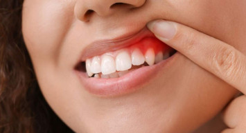 Diş eti iltihabı neden oluşur? Diş eti iltihabına iyi gelen besinler ve tedavisi