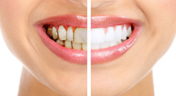  Diş Taşı Neden Olur, Diş Taşı Nasıl Geçer? 