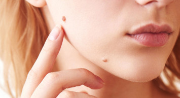 Doğal Çözümler ile Yüzdeki Benlerden Kurtulun