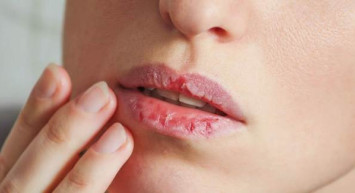 Dudak Çatlamasının Nedenleri Nelerdir? 