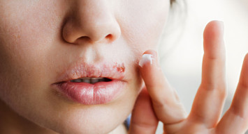 Uçuğa ne iyi gelir, ne sürülür, ruj sürmek faydalı mıdır? Uçuğu anında kurutacak doğal yöntemler 