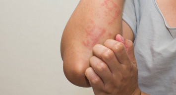 Egzama zannedip hafife almayın cilt kanseri belirtisi olabilir