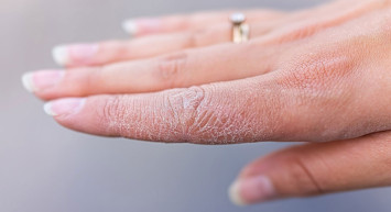 Egzamada nelere dikkat edilmeli, egzamaya hangi yağ iyi gelir? Egzamayı geçirecek doğal yöntemler 