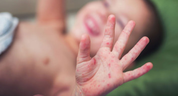 El Ayak Ağız Hastalığı Nedir, Belirtileri ve Tedavi Yöntemleri Nelerdir?