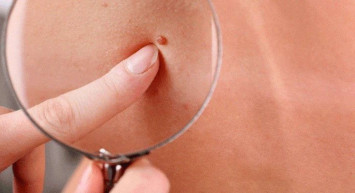 Et beni nedir, nasıl düşürülür? Et benlerini döken evde hazırlayabileceğiniz doğal tarifler