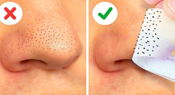 Evde yapacağınız 2 maskeyle siyah noktalara veda vakti! Evinizde olan malzemelerle siyah noktalar uçup gidecek