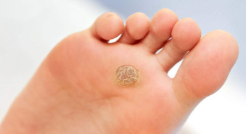 Genital siğil nedir, nasıl oluşur? 2022 Genital siğil tedavi yöntemleri