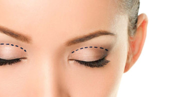 Göz kapağı düşüklüğü neden olur?  Göz kapağı düşüklüne neler iyi gelir? Göz kapağı düşüklüğünden bu tedaviyle kurtulabilirsiniz