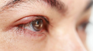 Göz Kapağı Kisti Nedir, Belirtileri Nelerdir, Nasıl Tedavi Edilir?