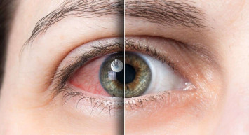 Gözde lens varken ağlanırsa ne olur? Lens kullananların dikkat etmesi gereken püf noktaları