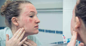 Gül Hastalığı Nasıl Tedavi Edilir?