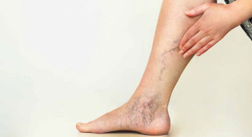 Hamilelikte Varis Oluşumu