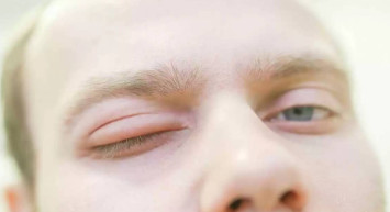 Herediter anjioödem nedir, belirtileri nelerdir? Herediter anjioödem tehlikeli mi, hangi bölüm bakar?