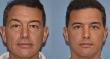 Herkes bu estetik cerrahını konuşuyor: Gençleştirme ameliyatı sonrası artık oğlundan daha genç görünüyor!