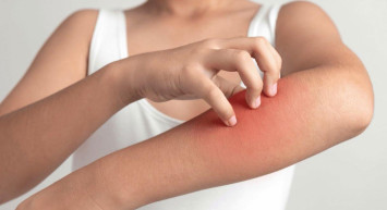 Hindi eti alerji yapar mı? Belirtileri nelerdir?