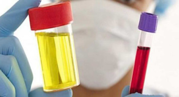 İdrarda Hemoglobin nedir, neden yükselir? Hemoglobin yükselme belirtileri