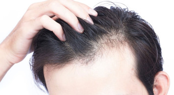 İnsanın en doğal süsü: Saçları! Saç dökülmesini önleyen besinler!