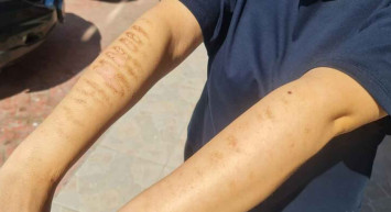 İzmit'te skandal olay: Epilasyon için gittiği güzellik merkezinde kolları yandı!