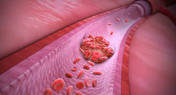 Kan pıhtılaşması nedir? Kan pıhtılaşması belirtileri nelerdir? Kan pıhtılaşmasını engellemek için yapılması gerekenler