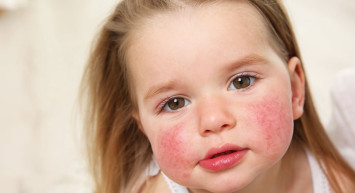 Kawasaki Hastalığı Nedir, Belirtileri ve Tedavi Yöntemleri Nelerdir?